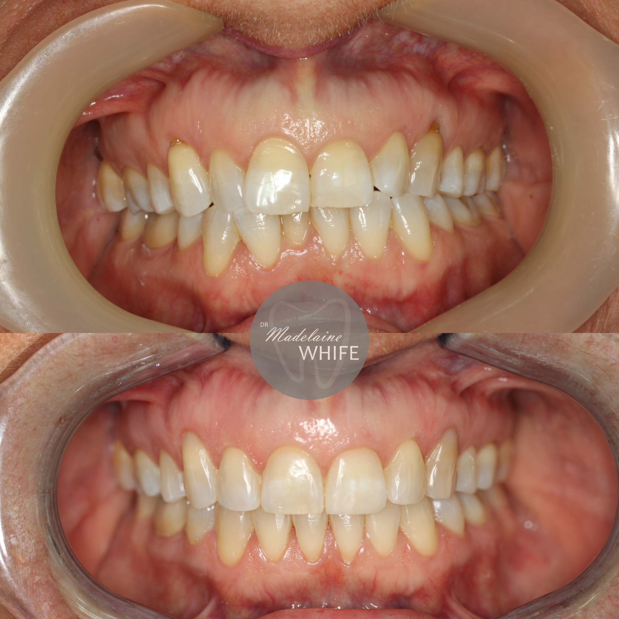 Patient 2 transformation